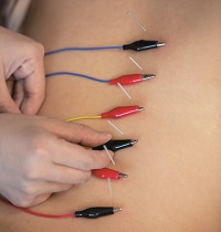Electro-acupunctuur