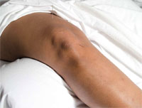 Acupunctuur bij artrose